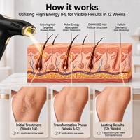 Hair Removal Epilator